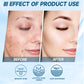 Oligopeptide Anti-Acne Serum – EGF Repair & Moisturizing