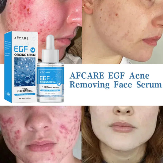 Oligopeptide Anti-Acne Serum – EGF Repair & Moisturizing