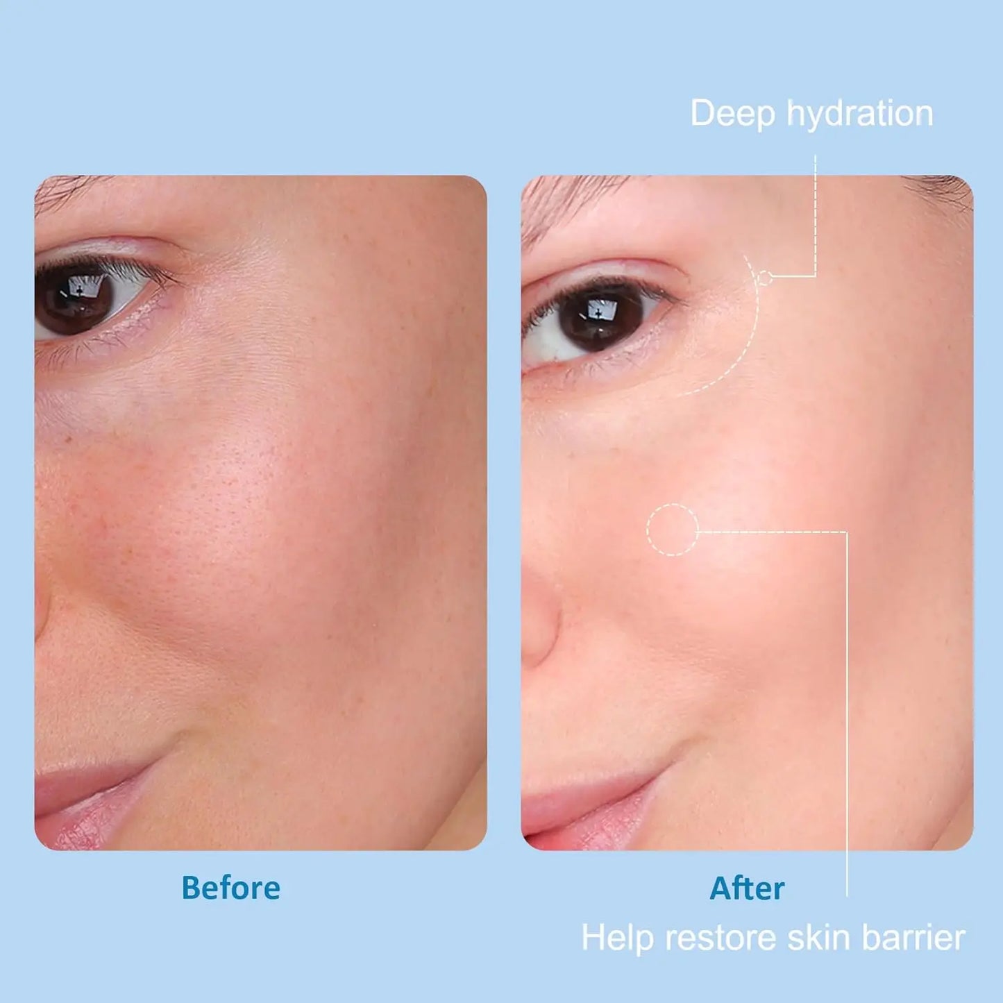 5-in-1 Hyaluronic Acid Skincare Set – Salon & Home Use