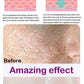 Facial Skin Peel Serum – Chemical Peel for Acne & Wrinkles