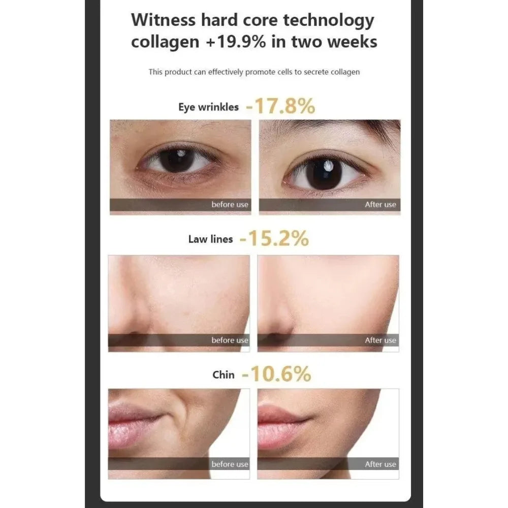 ProLift 7-in-1 RF & EMS Facial Tightening Device