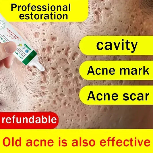 Men's Anti-acne Mark Pothole Repair Cream-Regeneration gel