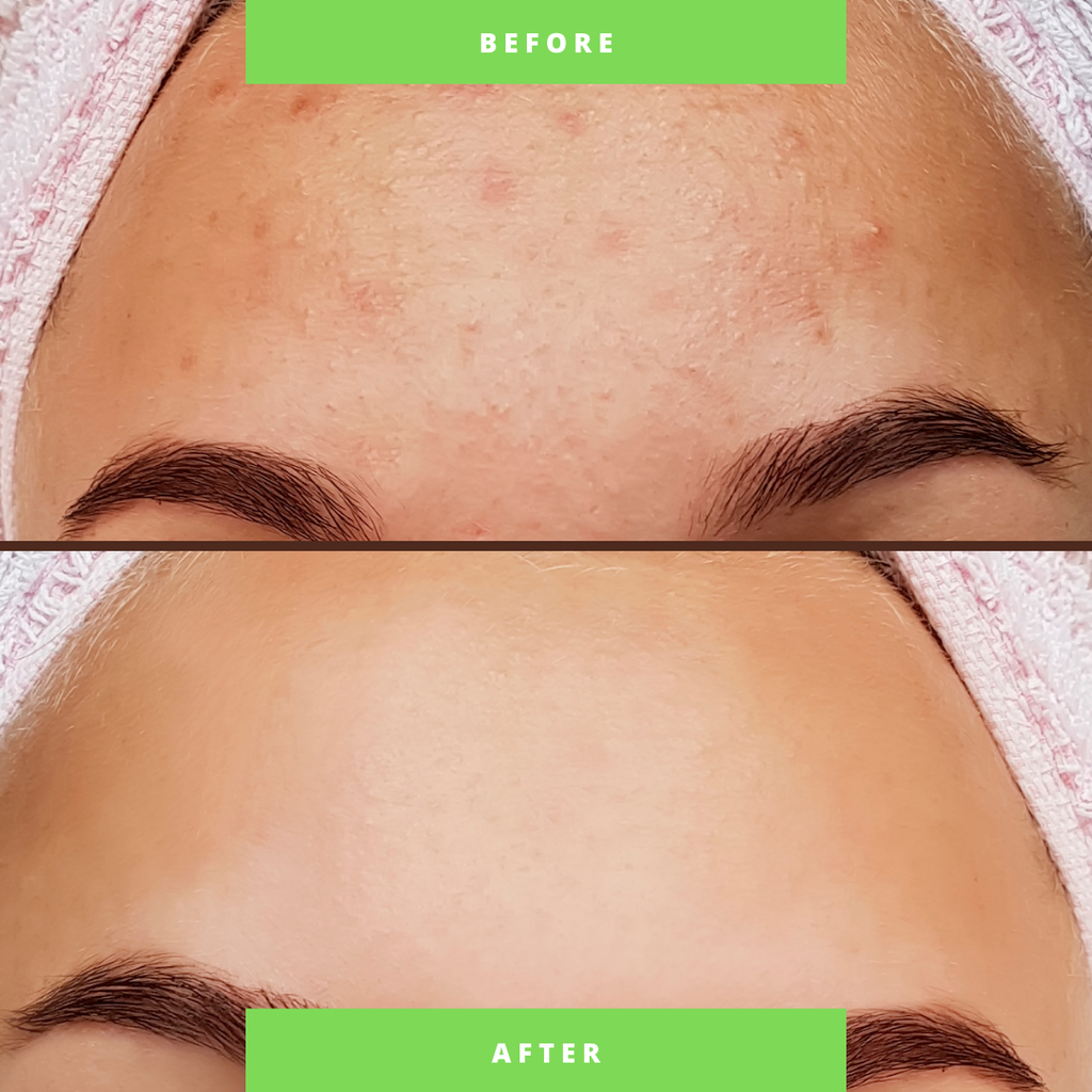 Organic Two-Step Anti-Acne Facial System = For WOMEN-1